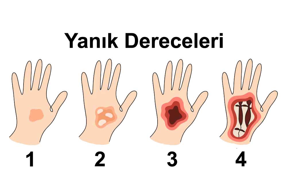 Evde yanık hızmeti