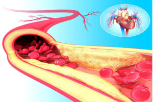 evde Damar tıkanıklığı