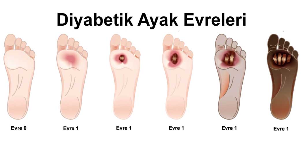 Evde Diyabetik Ayak Pansumanı