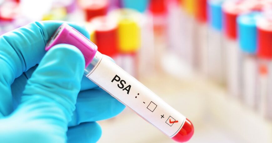 PSA Testi