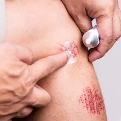 Yaraların Çabuk İyileşmesi İçin Hangi Krem Kullanılır?