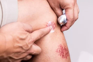 Yaraların Çabuk İyileşmesi Krem