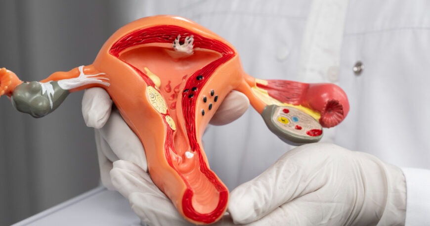 Rahim Ağzı Kanseri (serviks)